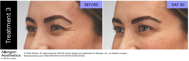Botox before and after: eye area at Day 30