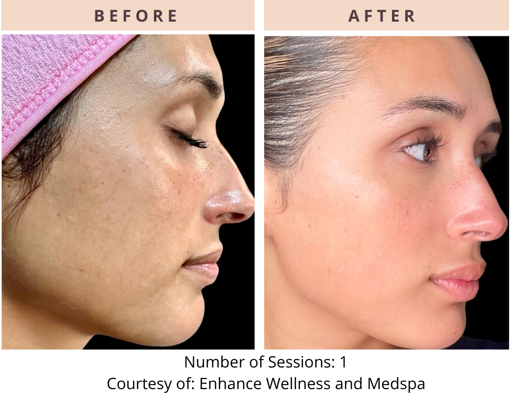 CoolPeel before and after
