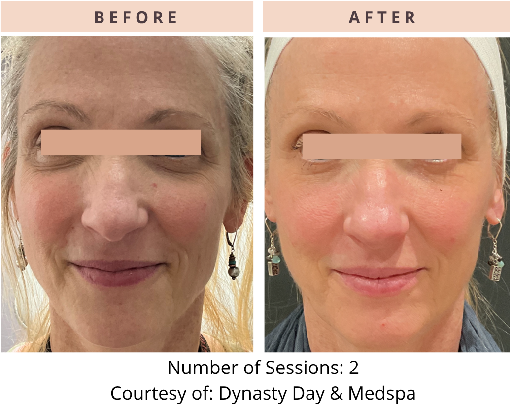CoolPeel before and after