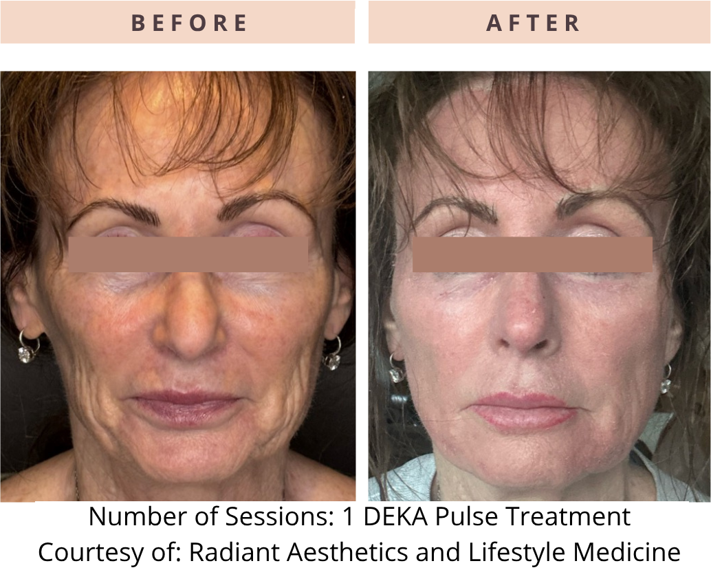 DEKA before and after
