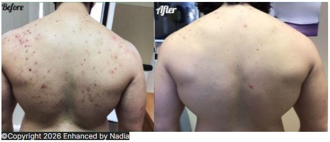 Microneedling before and after: back