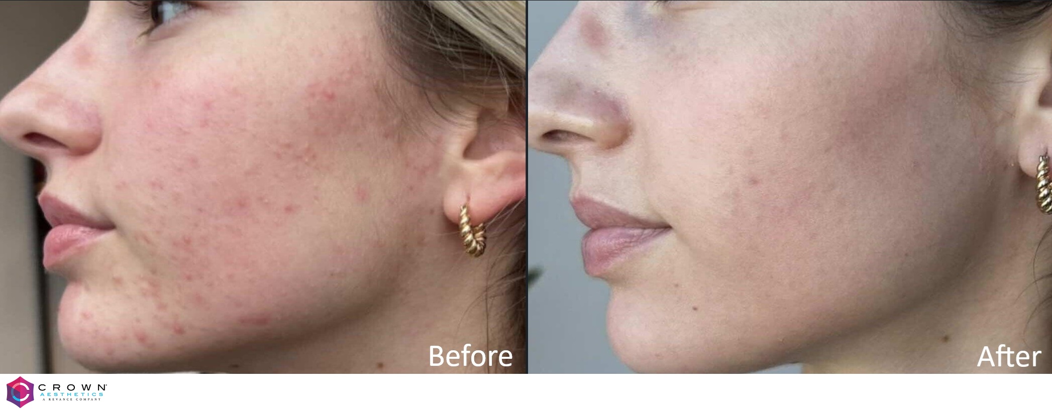 Microneedling before and after: acne scarring