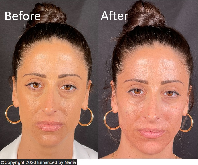 HA filler before and after: full face