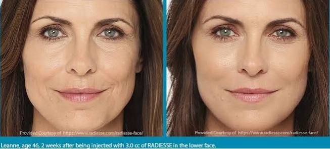 Radiesse before and after